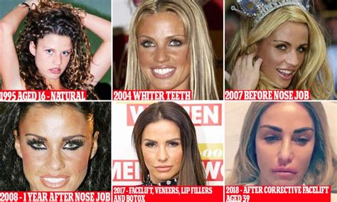 katie price teeth before and after|Katie Price exposes huge gap after her tooth falls out。